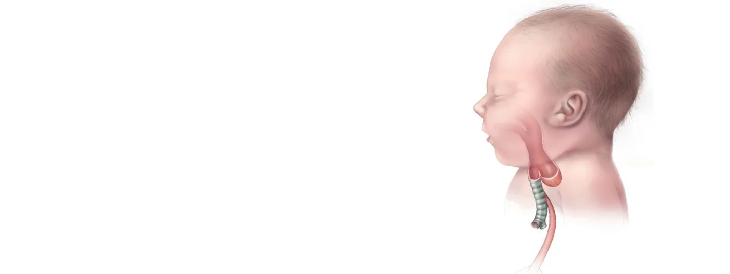 Everything You Must Know About Esophageal Atresia